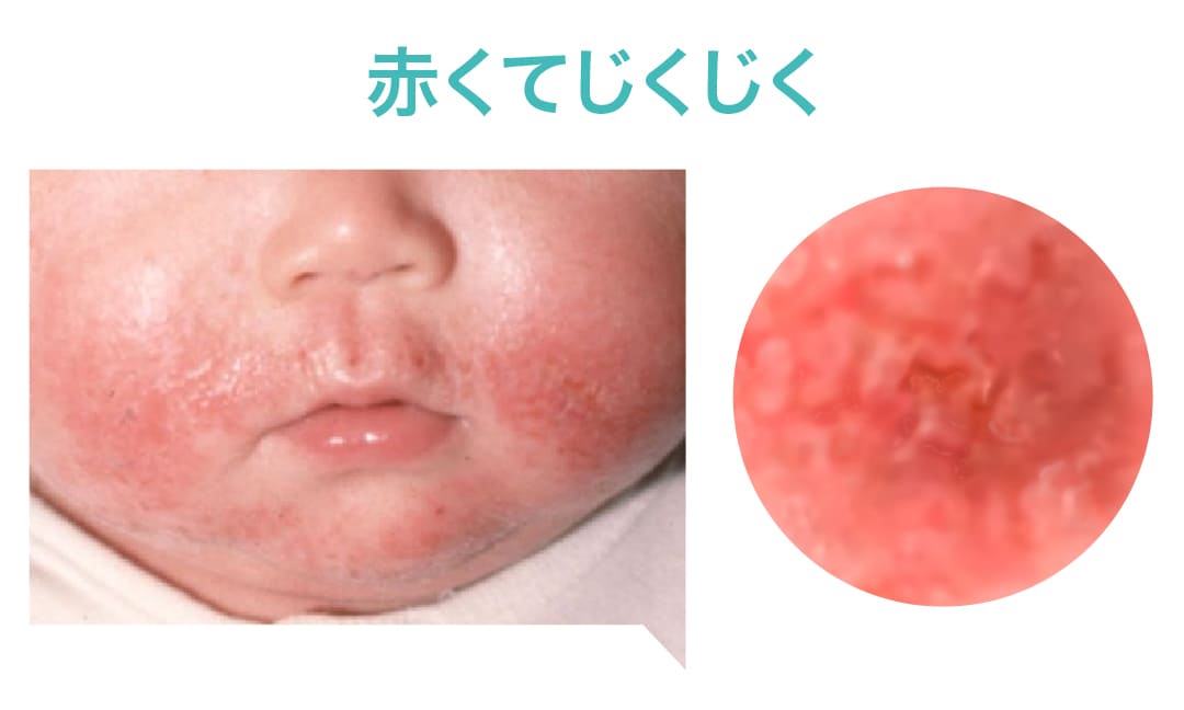 赤くてじくじく